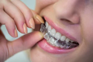 Clear-aligners in kerala,India