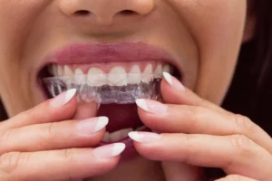 Teeth straightening Treatment in kerala