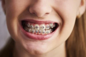 Invisible Braces in kerala