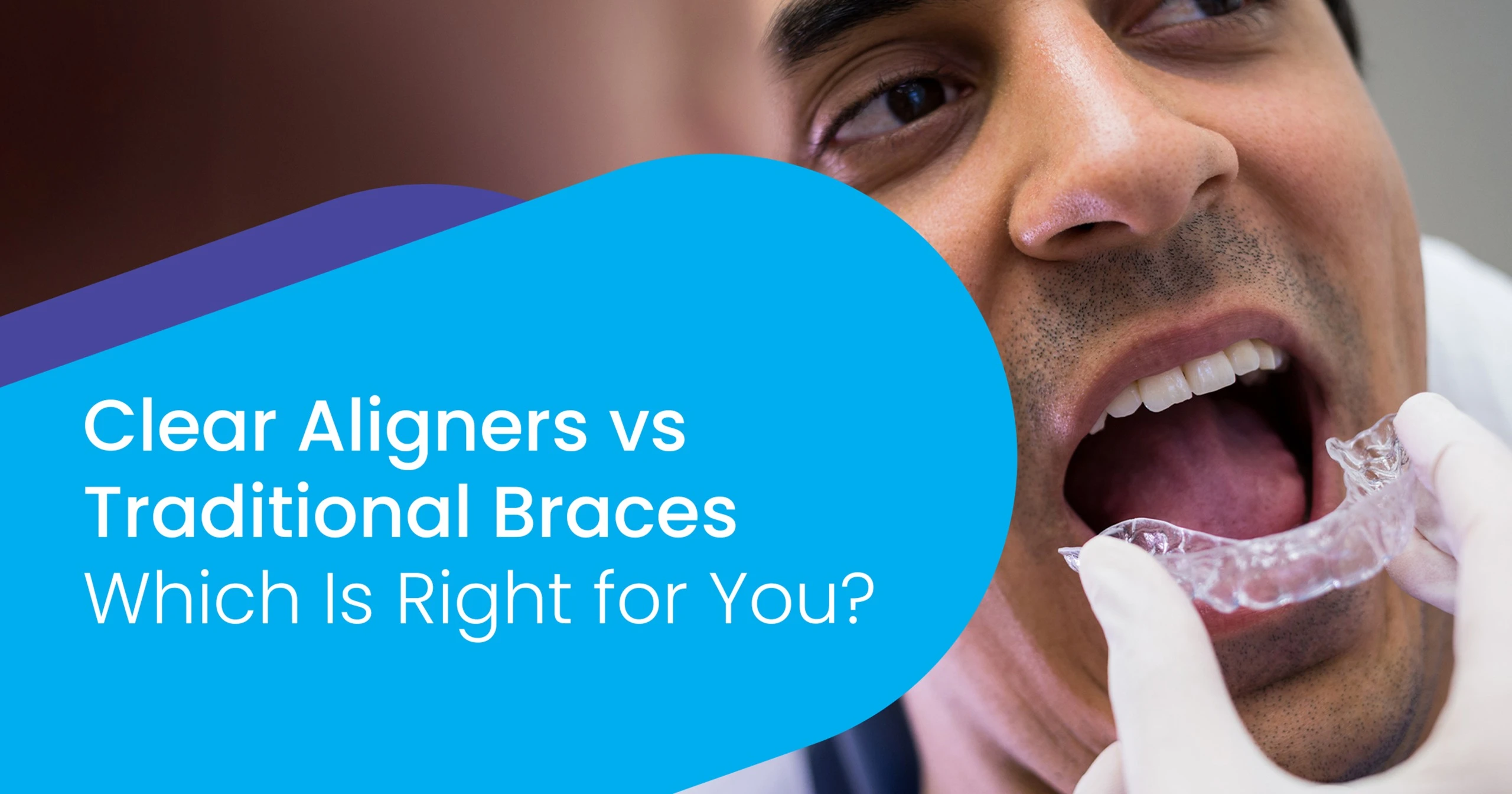 Clear Aligners vs Traditional Braces