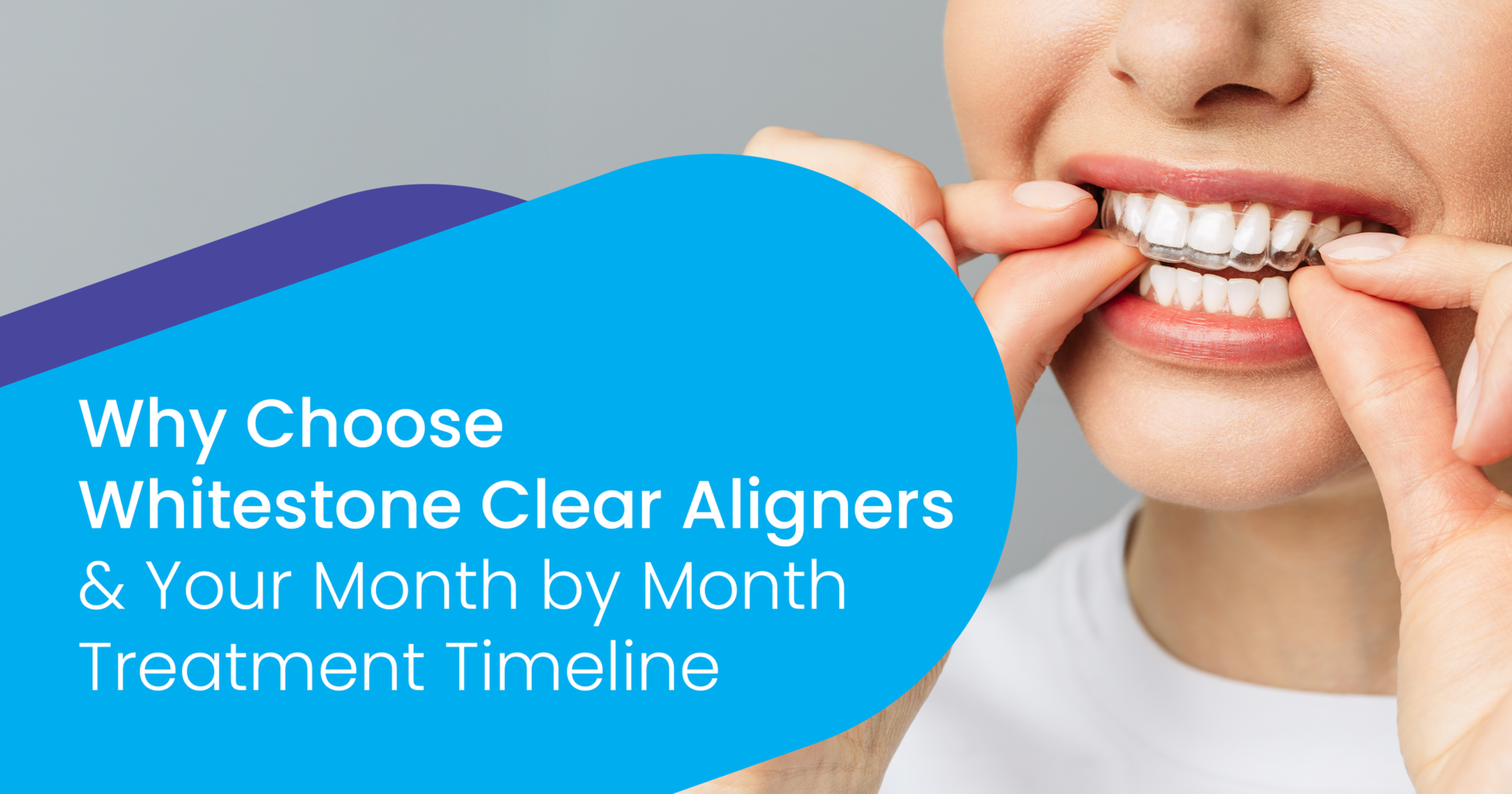 Whitestone Clear aligners in kerala