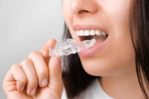 Whitestone Clear Aligners – Best Invisible Aligner Brand in Kerala