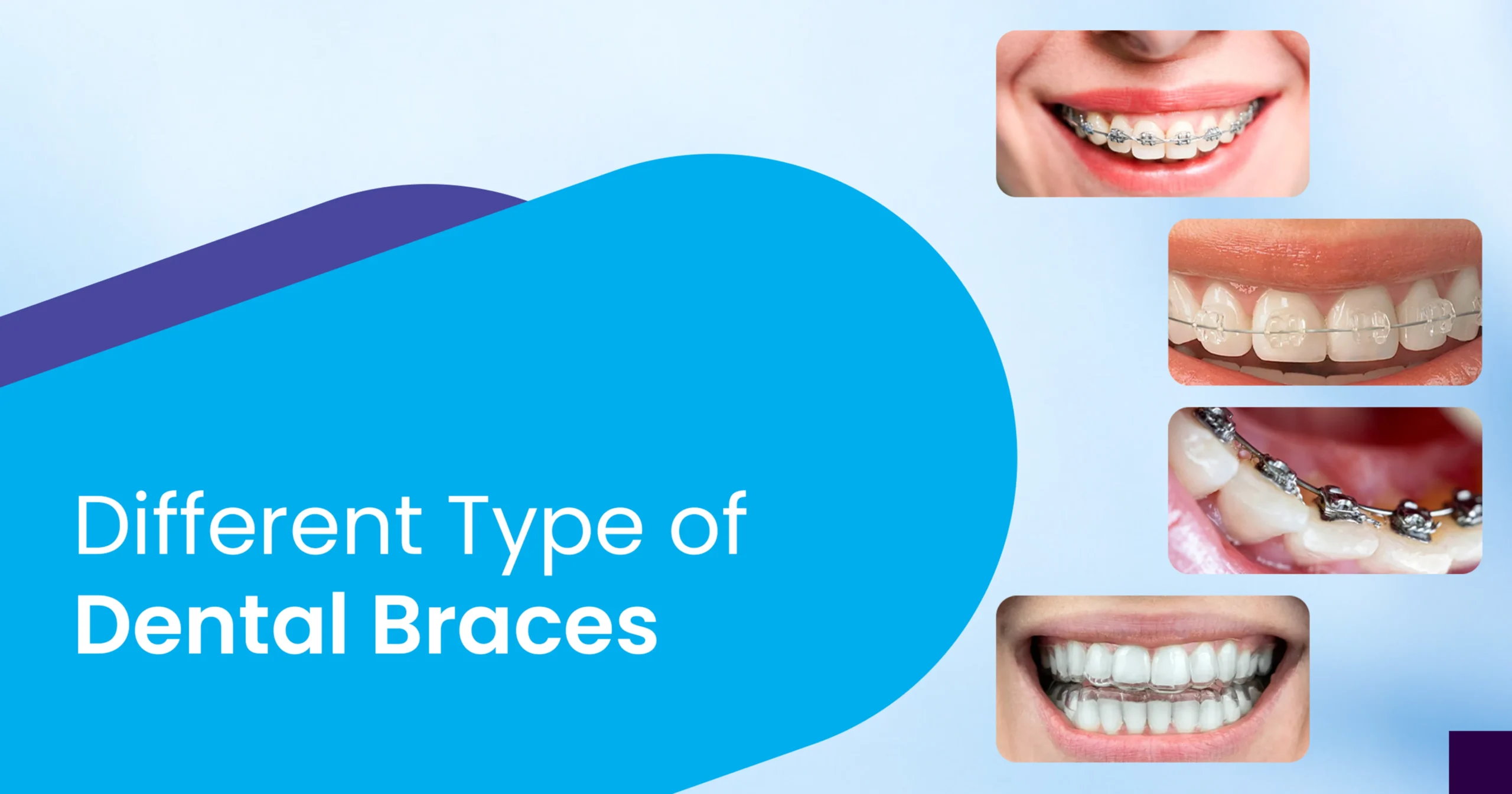 Different types of braces