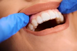 Discreet teeth straightening with White Stone Clear Aligners