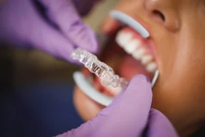 Patient wearing clear aligners for overbite correction