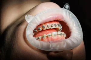 Types of Dental Braces