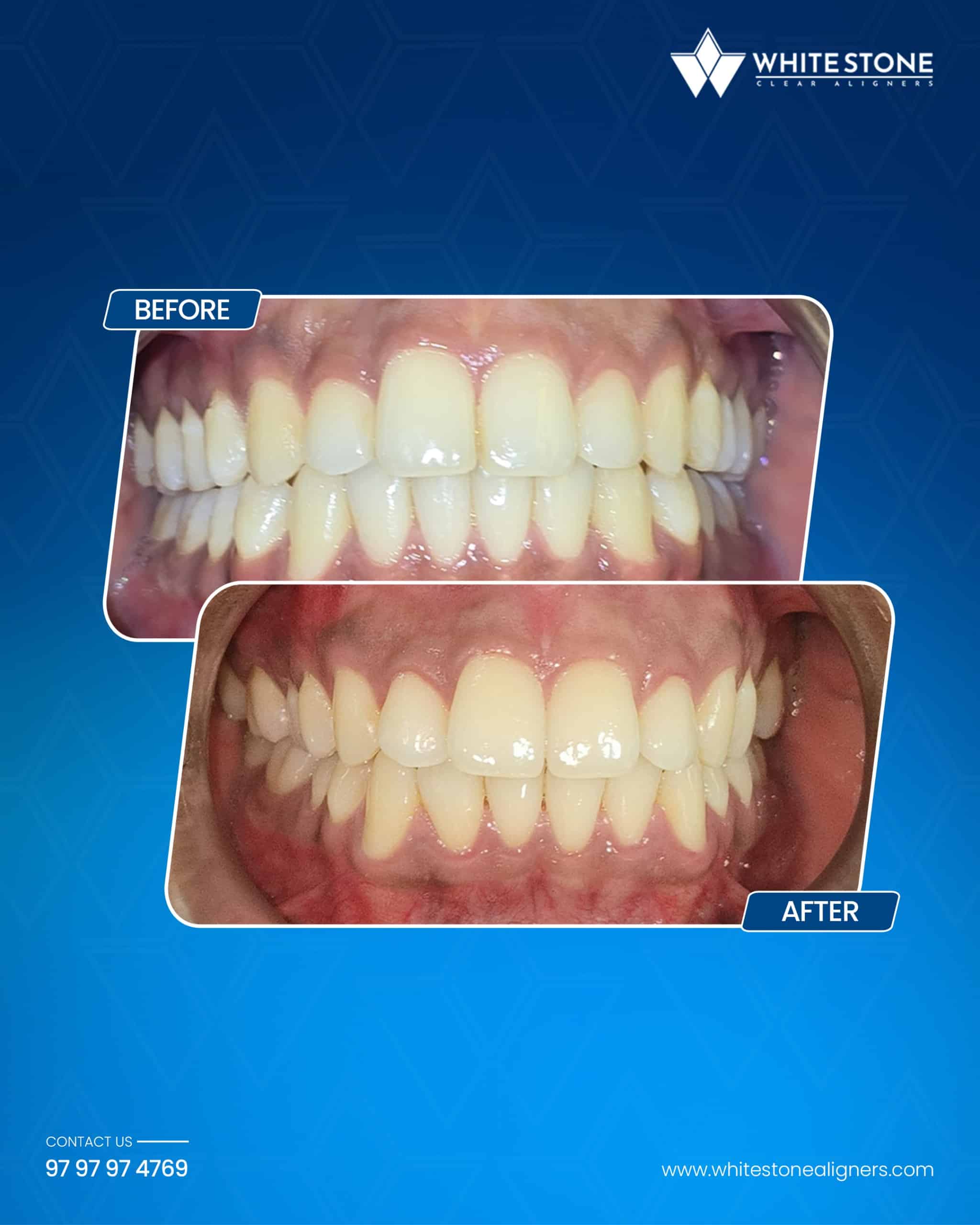 Before and after comparison of misaligned or rotated adult teeth improved with White Stone clear aligner treatment.