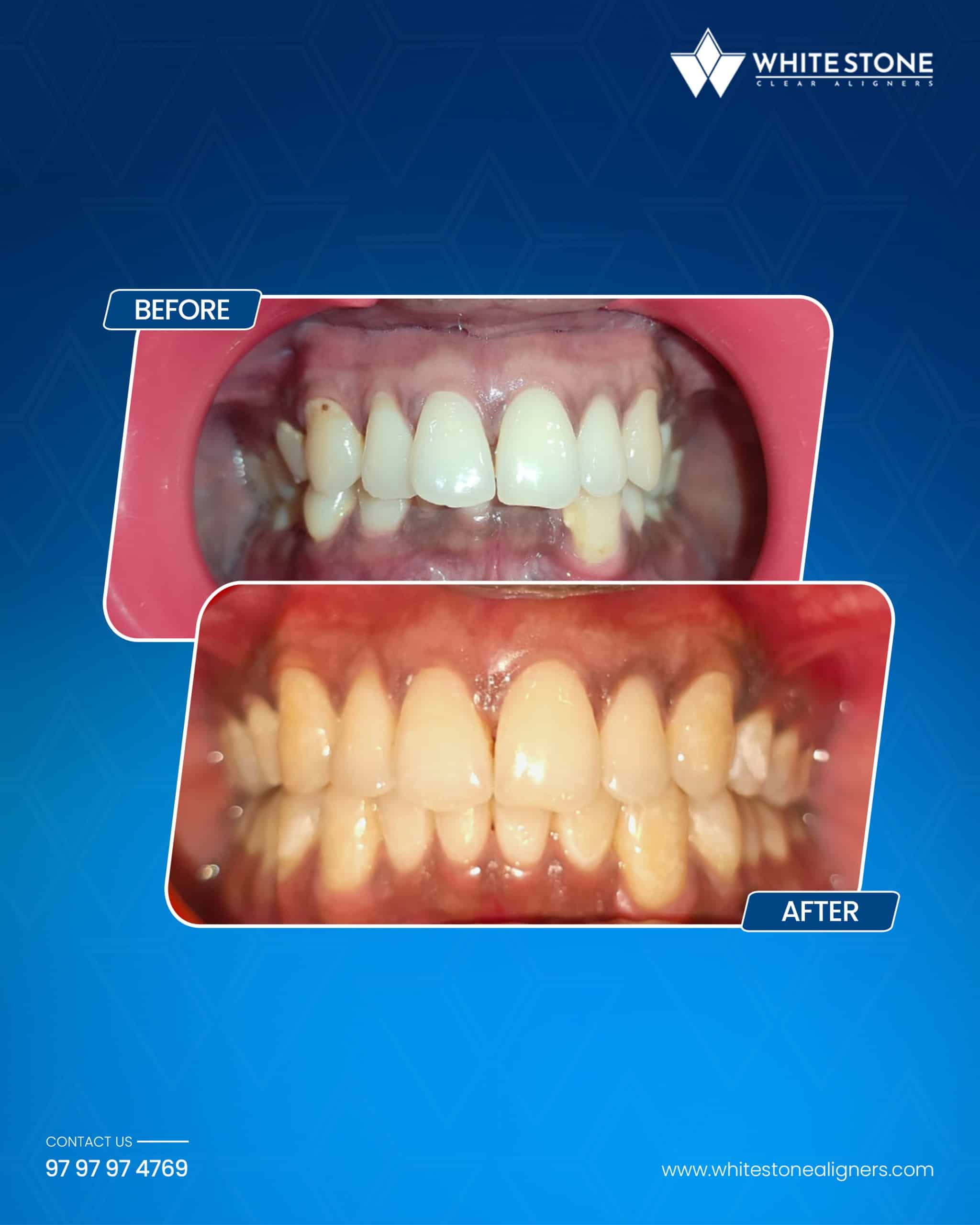 Before and after image showing mild teeth crowding corrected with White Stone clear aligners for adults.