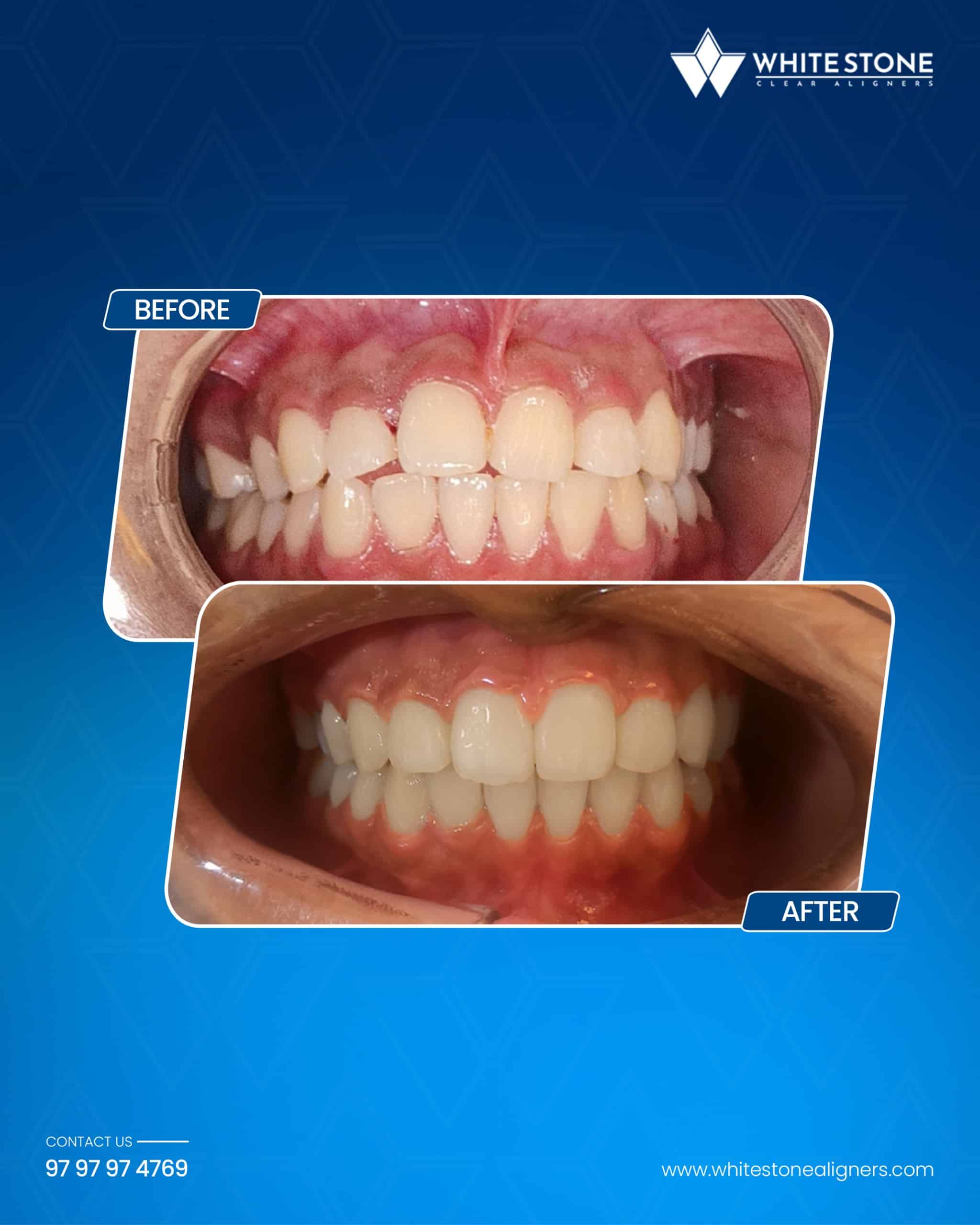 Before and after showing subtle bite correction and straighter teeth achieved with adult clear aligner treatment.