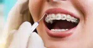 What to Look for in Orthodontists