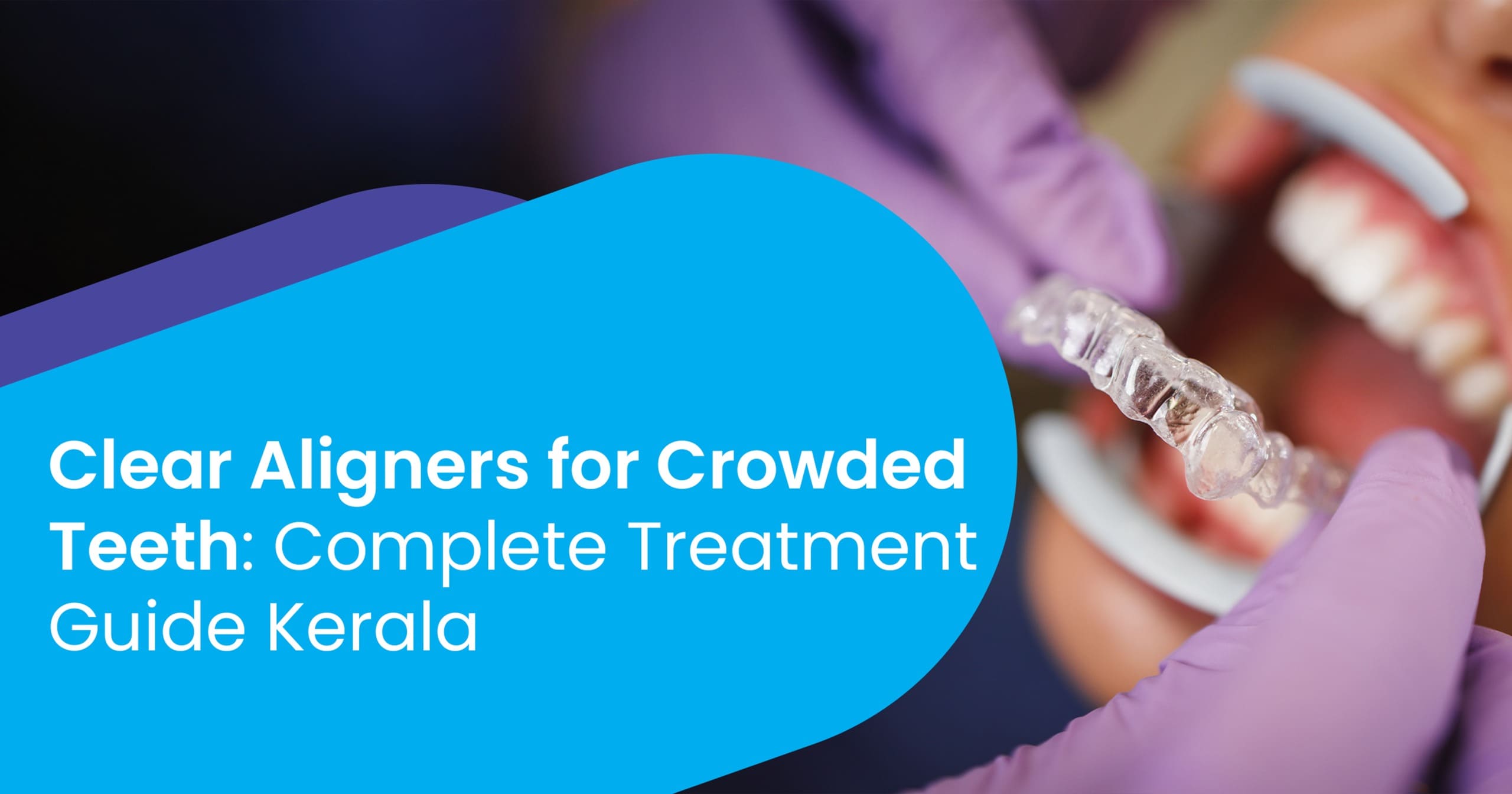 Clear aligners for crowded teeth showing before and after transformation in Kerala patient