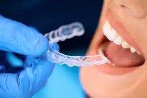 Why Kerala Chooses White Stone Aligners 
