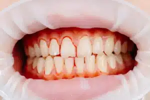 Who Is Not Suitable for Clear Aligners?