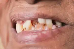 Who Is Not Suitable for Clear Aligners