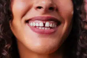 Challenges caused by tooth gaps