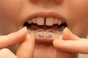 Clear Aligner Treatment Process for Teeth Gaps