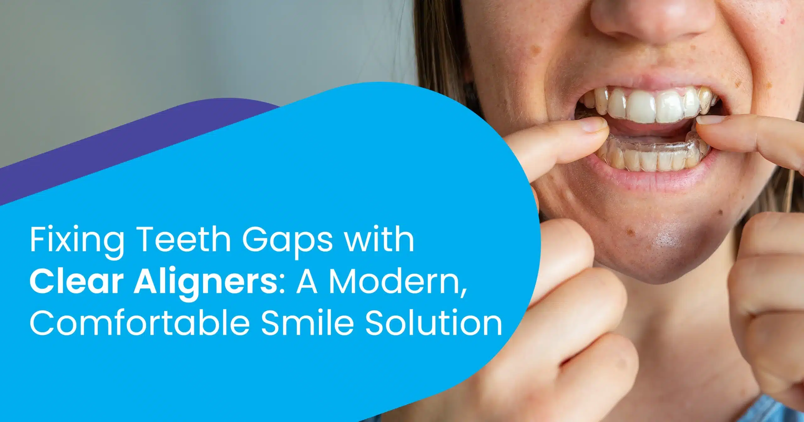 Fixing Teeth Gaps with Clear Aligners
