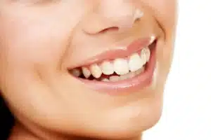 Teeth Shifting After Aligners