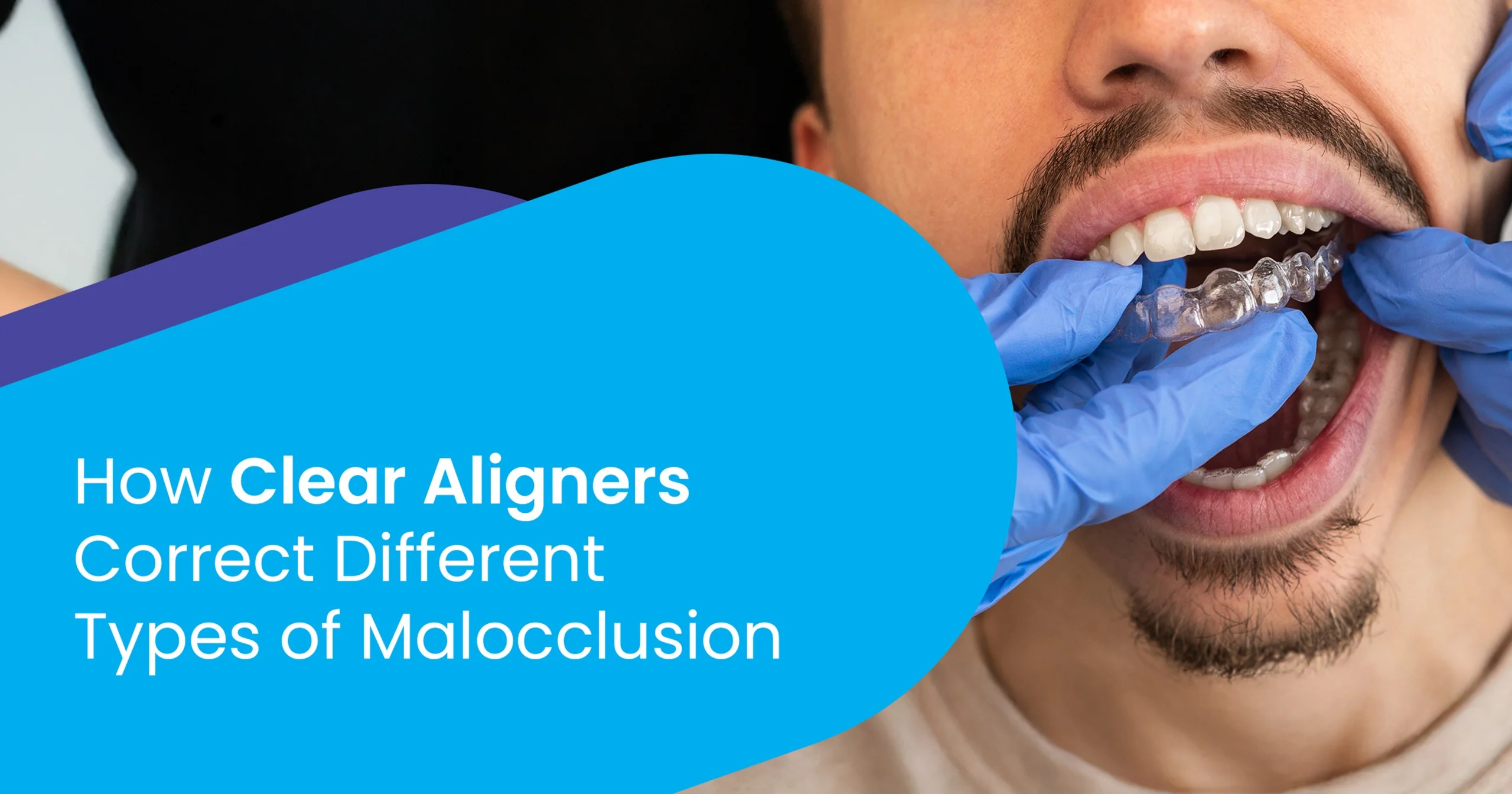 clear aligners for malocclusion correction