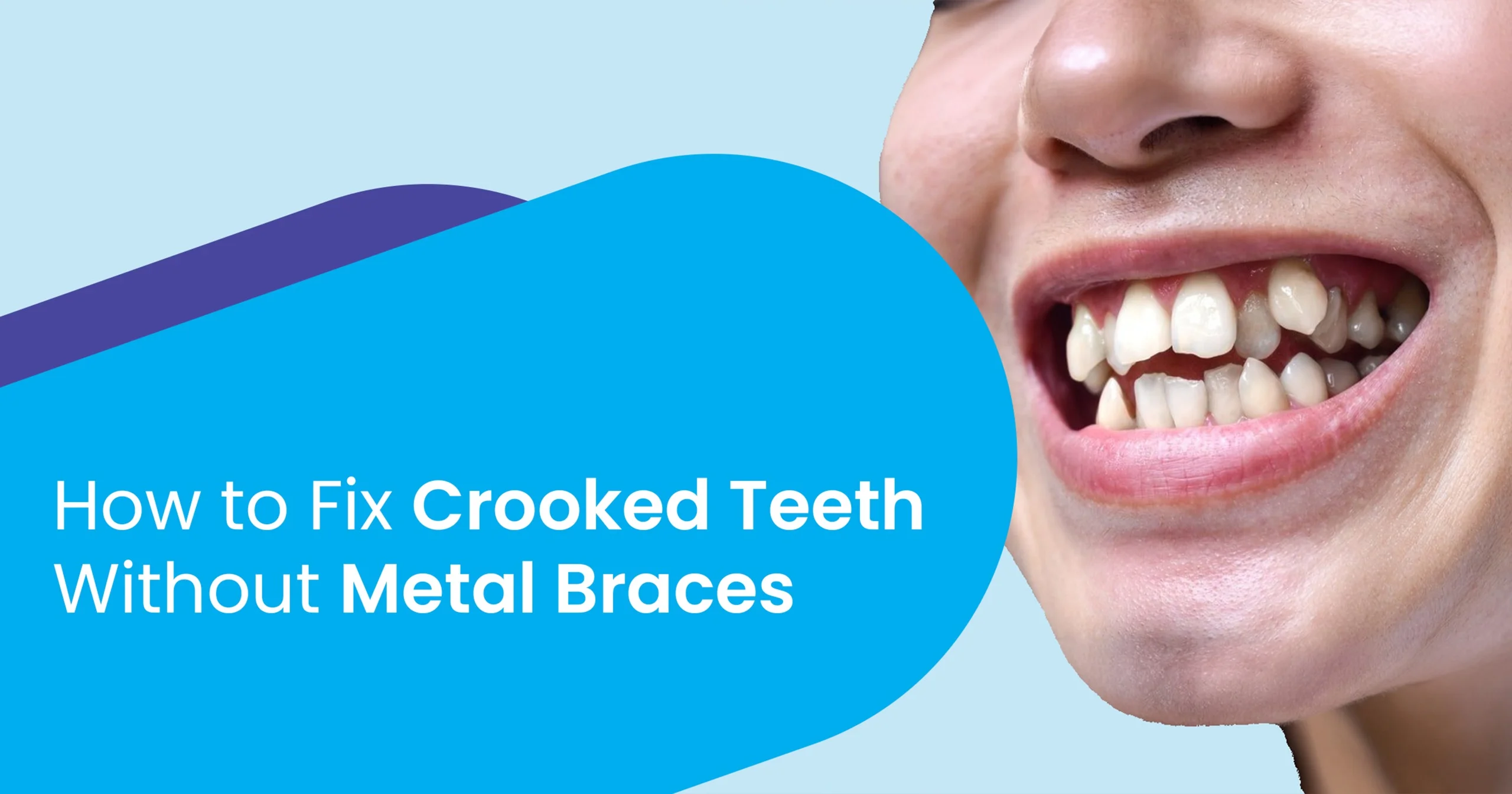 How to Fix Crooked Teeth Without Metal Braces