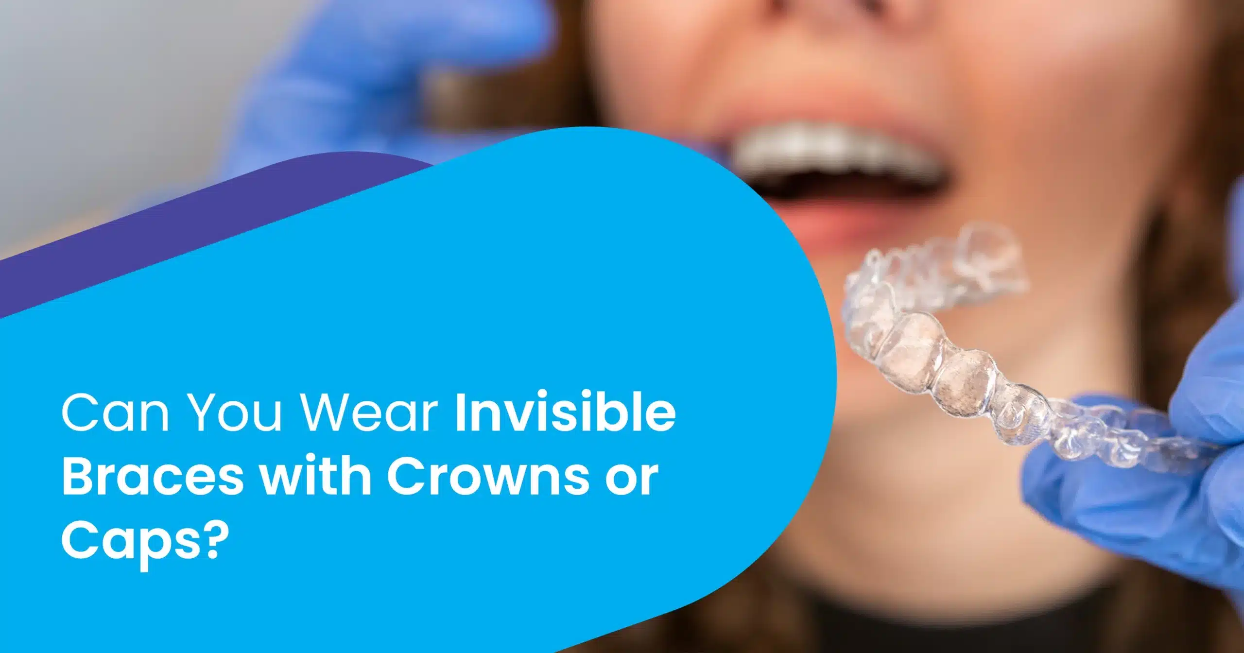 Can You Wear Invisible Braces with Crowns or Caps