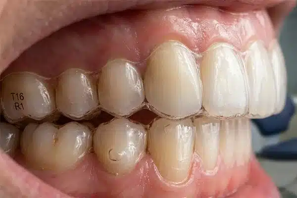 Do Clear Aligners Damage Crowns or Caps