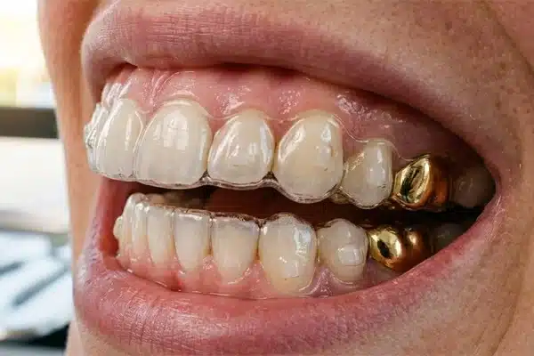 How Do Clear Aligners Work with Crowns