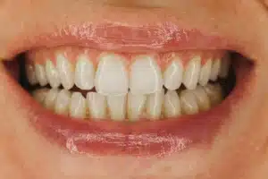 After Clear Aligner Treatment
