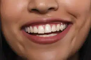 Teeth Alignment Maintenance