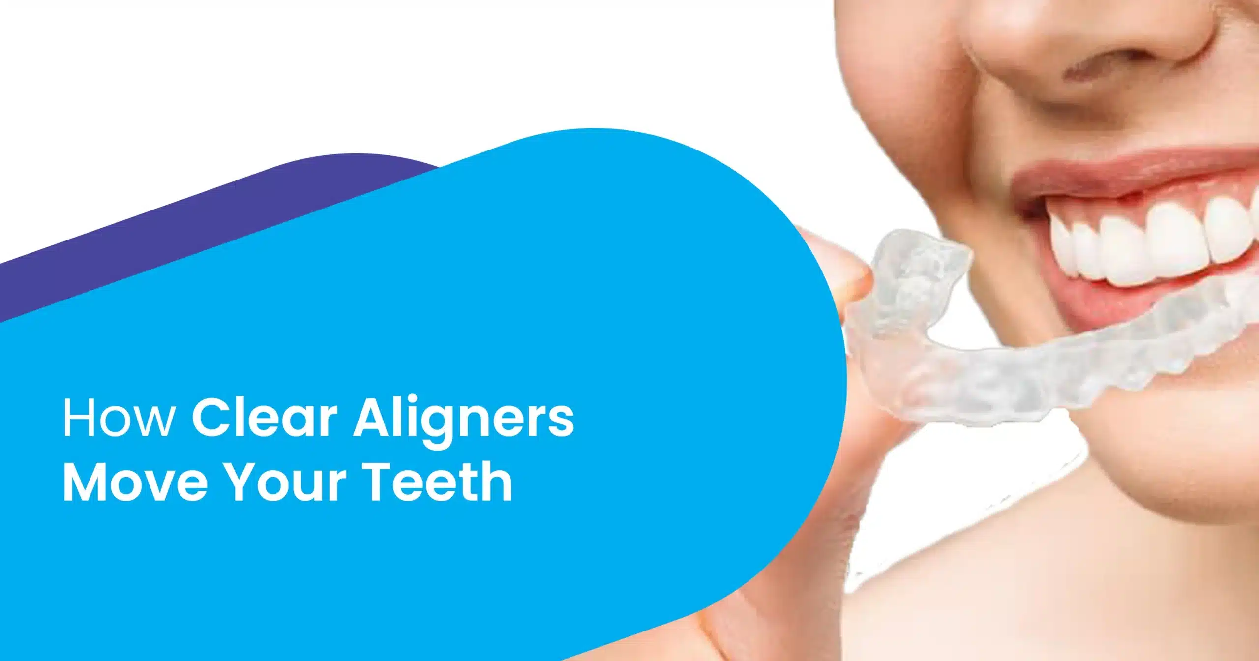 Clear Aligners Move Your Teeth