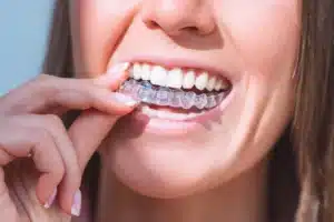 Common Challenges With Clear Aligners