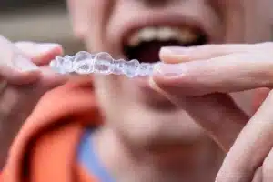 How Do Aligners Work to Move Your Teeth