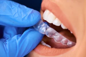 Can Retainers Straighten Teeth Without Braces