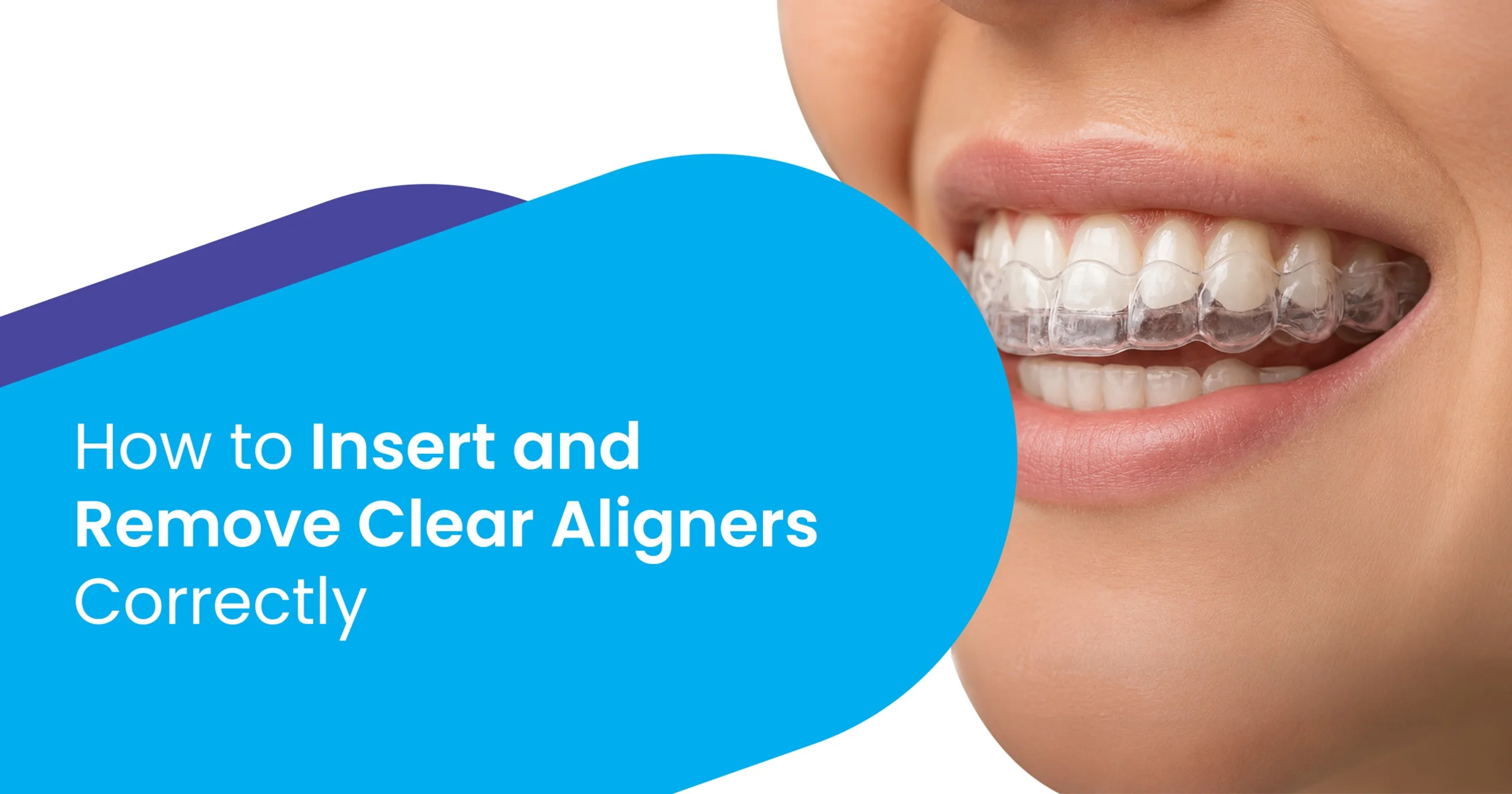 Insert and Remove Clear Aligners