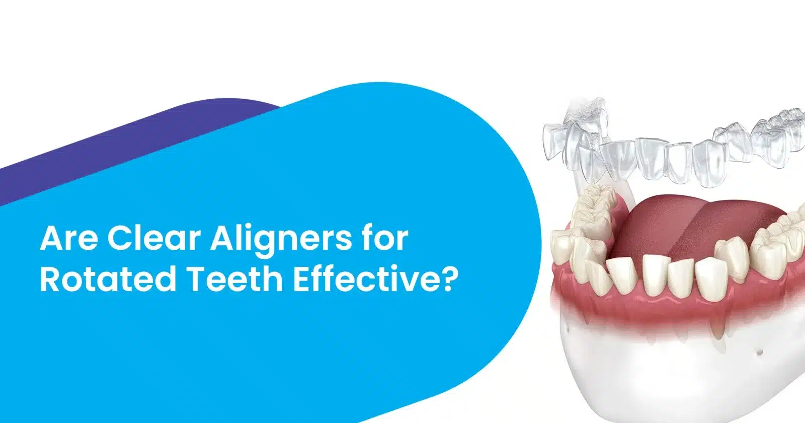 Clear Aligners for Rotated Teeth