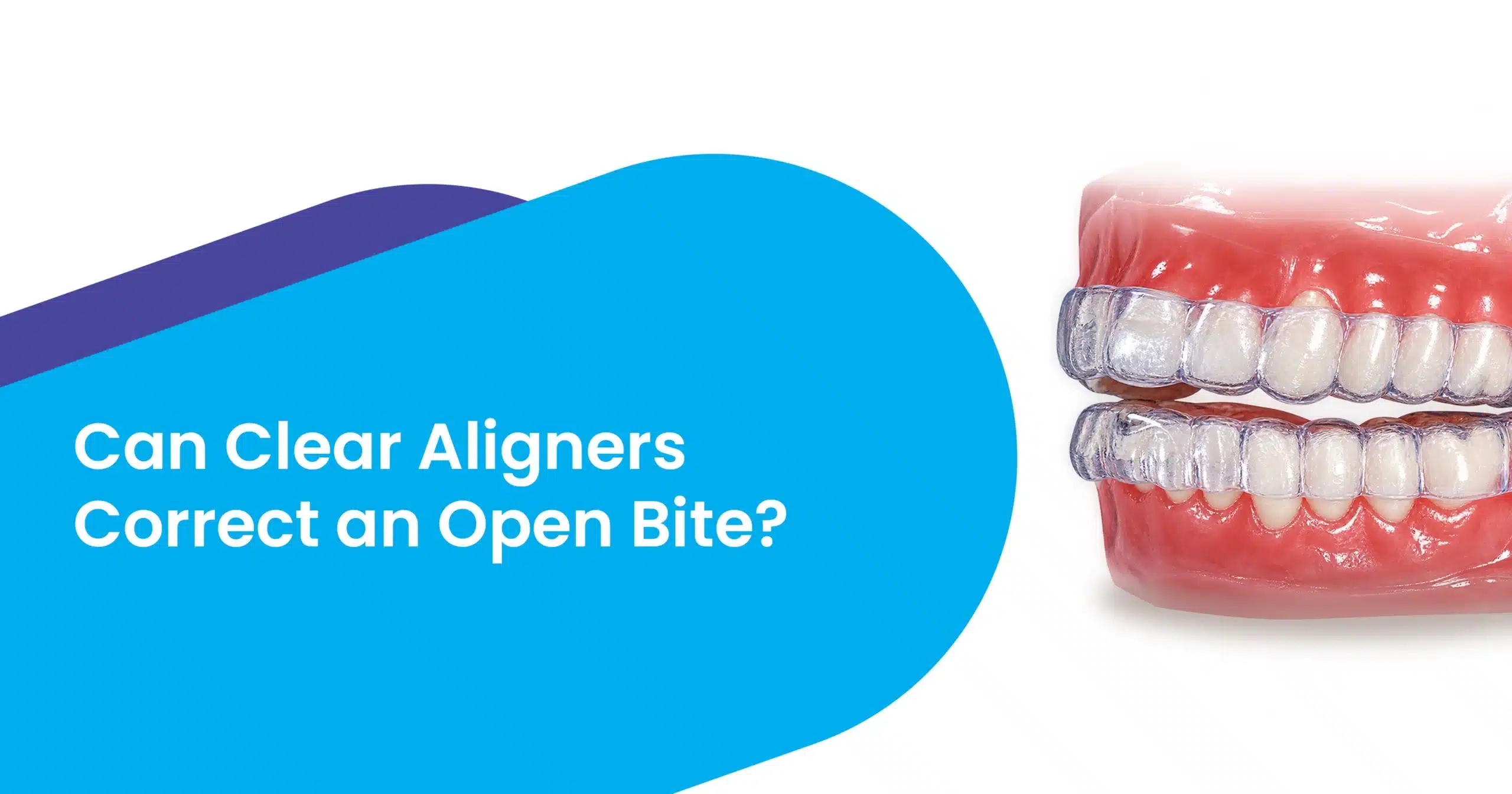 Clear Aligners Correct an Open Bite