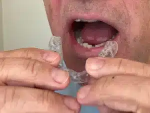 How to Know If You Have Clear Aligners Not Fitting Properly