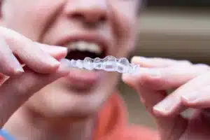 How to Resolve the Issue of Clear Aligners Not Fitting Properly