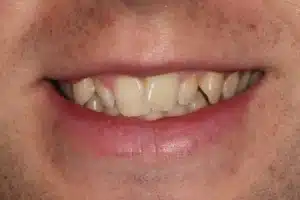 What Are Rotated Teeth