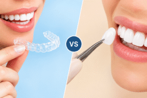 Clear Aligners vs Veneers