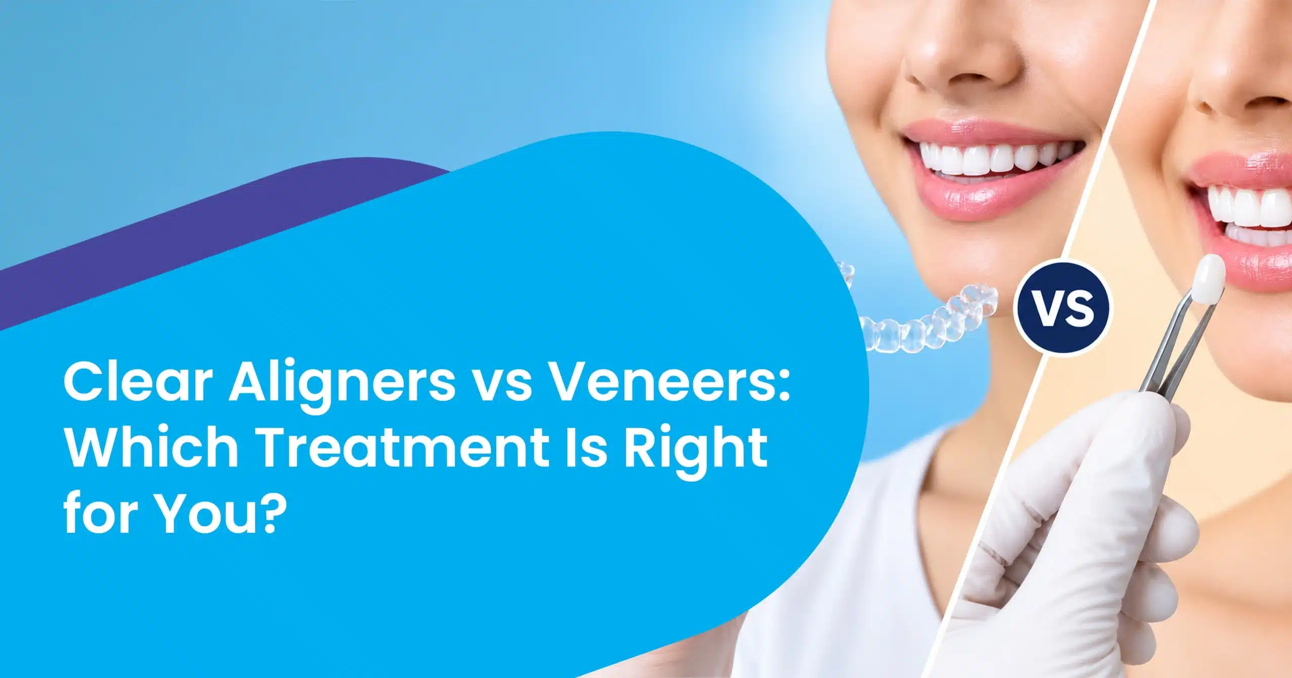 Clear Aligners vs Veneers Which Treatment Is Right for You