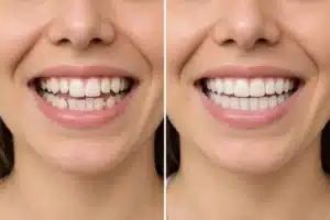 How Long Do Clear Aligner Results Last Without a Retainer