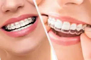 How Quickly Can Teeth Shift After Braces